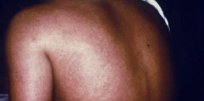 A woman with Marburg virus infection has a rash on her back