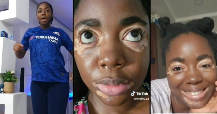 Lady shares how she got vitiligo after giving birth (video)