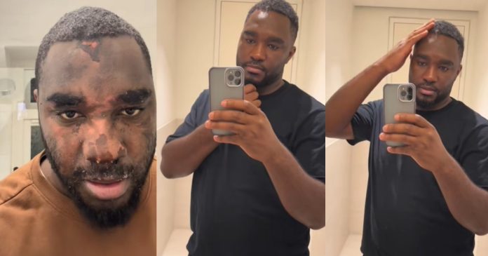 "13 months recovery" – Man shares remarkable facial recovery after surviving pressure cooker expl0sion (WATCH)